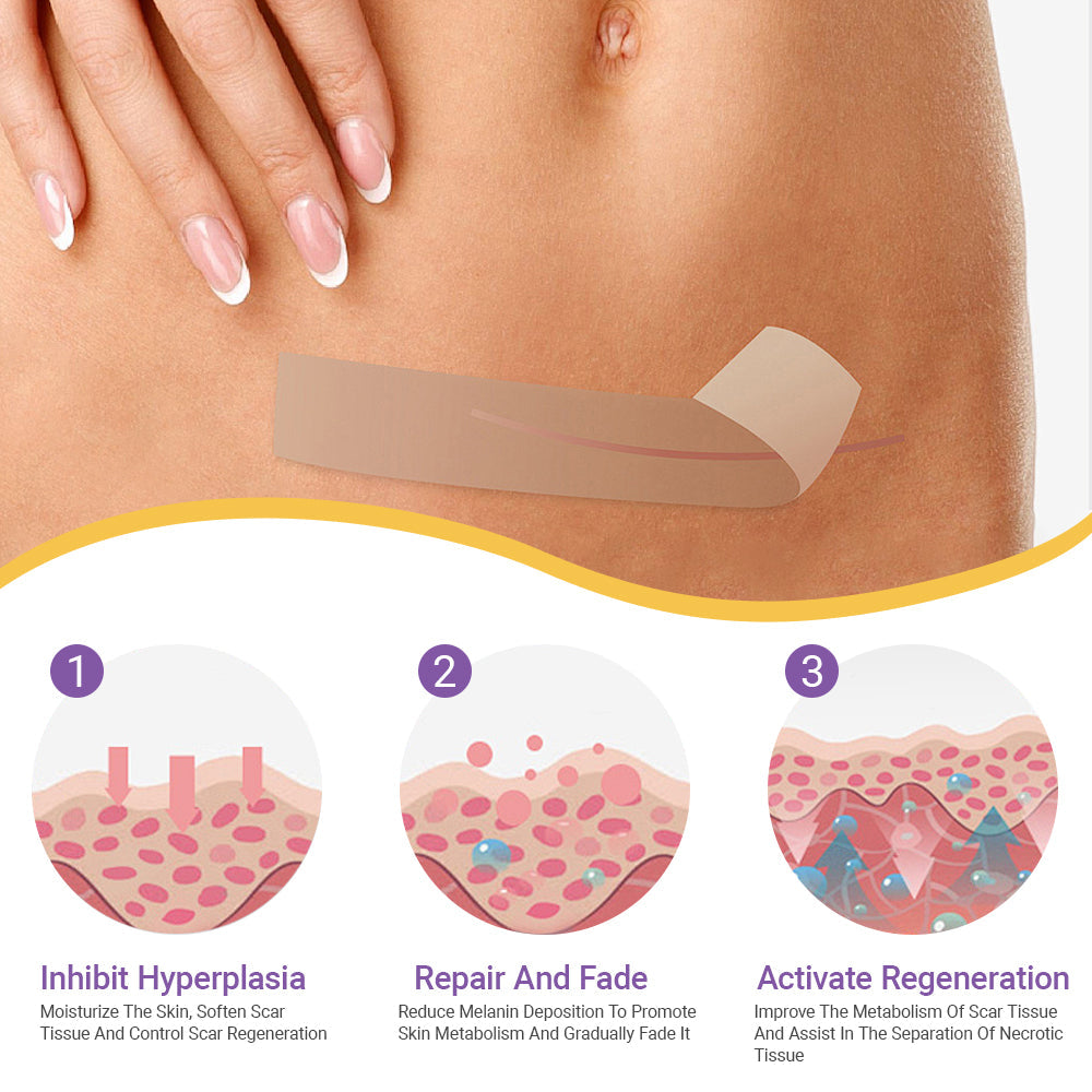 A bőrbizalom itt kezdődik ✅ Bostore® hialuronsavas nano mikrotűs regeneráló tapasz ✴️ Különféle hegek, striák, foltok, keloidok, keratózis, akne, égési sérülések, szemölcsök, bőrcímkék és visszerek kezelésére.